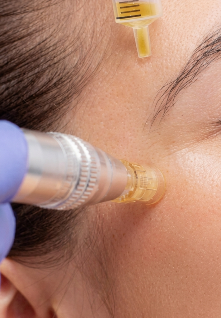 Hien Beauty - microneedling course